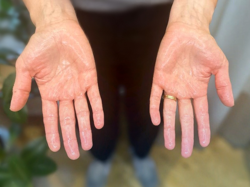 bli av med handsvett